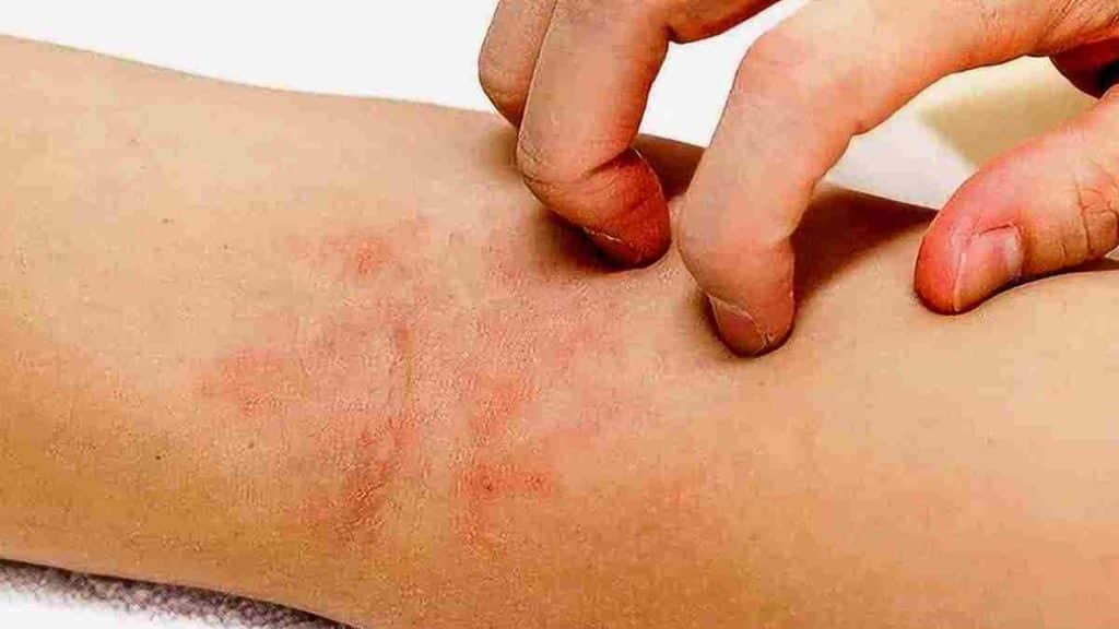 Les symptômes manifestant une allergie au nickel, les différentes réactions du corps